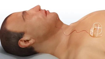 Μεγάλη Βρετανία: Πρωτοποριακό εμφύτευμα στο στήθος θεραπεύει την υπνική άπνοια