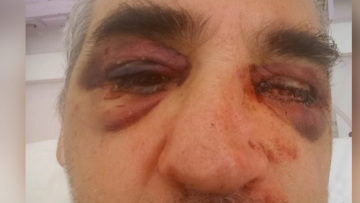 Μύκονος: «Κάποιοι δεν μας γουστάρουν επειδή κάνουμε τη δουλειά μας» είπε ο αρχαιολόγος που ξυλοκοπήθηκε