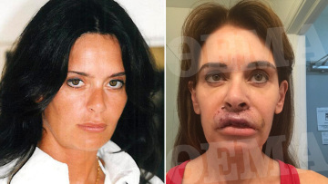 Ελληνίδα συγγραφέας είδε τα χείλη της να «σαπίζουν» μετά από πλαστική επέμβαση