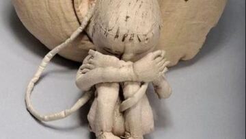 Μαία του 18ου αιώνα επινόησε ένα υφασμάτινο ομοίωμα γεννητικών οργάνων και μείωσε τη βρεφική θνησιμότητα