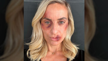 Ελεονώρα Μελέτη: Φωτογραφίζεται ως θύμα ξυλοδαρμού και μιλά για την κακοποίηση