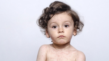 Ιλαρά: Σχεδόν 1.000 κρούσματα από 6 χώρες της ΕΕ δηλώθηκαν μέσα σε δύο ημέρες – Στη Ρουμανία τα περισσότερα