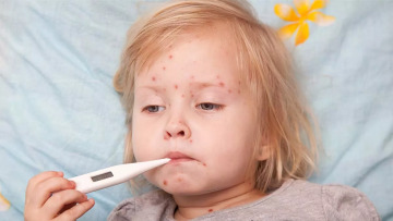 Ομοσπονδία Παιδιάτρων: Έκκληση στο υπουργείο Υγείας για τη συμμετοχή τους στη διαχείριση της ιλαράς