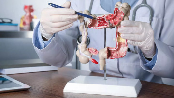 Καρκίνος παχέος εντέρου: Η πρώτη αιτία θανάτου για τους κάτω των 50 ετών – Στα 66 έτη μειώθηκε η μέση ηλικία διάγνωσης