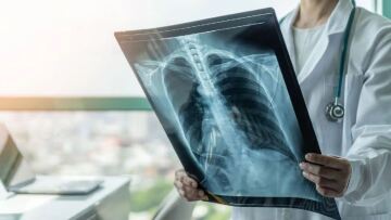 Η φυματίωση παραμένει η φονικότερη μολυσματική νόσος παγκοσμίως, με 1,23 εκατ. θανάτους το 2024