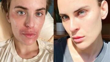 Ταλούλα Γουίλις: Μίλησε για την ψυχαναγκαστική διαταραχή από την οποία πάσχει - Σκαλίζει το δέρμα της