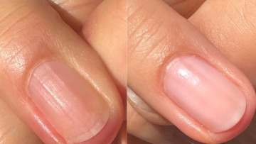 Τι σημαίνουν οι αυλακώσεις στα νύχια μας;