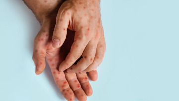 Σχεδόν 100 κρούσματα ιλαράς μέσα λίγες εβδομάδες στο Τέξας και το Νέο Μεξικό