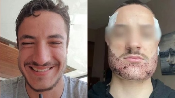 Γαλλία: 24χρονος αυτοκτόνησε μετά από αποτυχημένη επέμβαση για μούσια στην Κωνσταντινούπολη