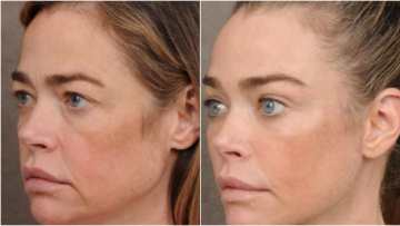 Ντενίζ Ρίτσαρντς: Φωτογραφίες με το πρόσωπό της πριν και μετά το λίφτινγκ