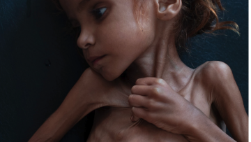 Το Facebook της λογοκρισίας: Διέγραψε τη συγκλονιστική φωτογραφία της 7χρονης στην Υεμένη που «σβήνει» από την πείνα