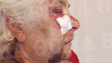 Ληστές ξυλοκόπησαν άγρια 80χρονη στo Αιγάλεω, της έσκισαν τα αυτιά για να της πάρουν τα σκουλαρίκια