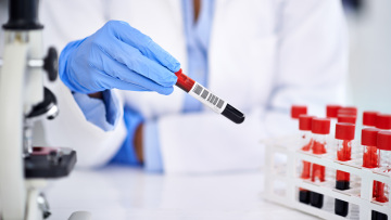 ΗΠΑ: Πράσινο φως για το πρώτο τεστ διάγνωσης του Αλτσχάιμερ με μια απλή εξέταση αίματος
