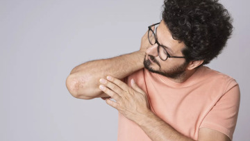 Ψωρίαση: Ανακαλύψτε τη βιταμίνη που αποτελεί φυσικό σύμμαχο για το δέρμα
