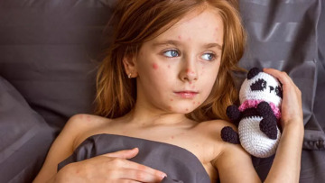 Η ιλαρά δεν είναι απλώς επικίνδυνη – Προκαλεί… αμνησία στο ανοσοποιητικό σύστημα