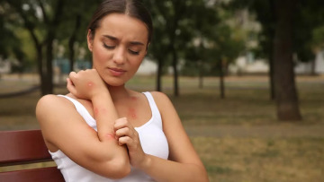 Έντομα: Τι να κάνετε αν σας τσιμπήσει μέλισσα, σφήκα, αράχνη ή τσιμπούρι