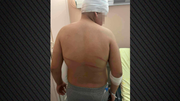 Θεσσαλονίκη: «Τον χτυπούσαν με μπετόβεργες, έχει τρύπες 15 πόντους στο κεφάλι» - Ξεσπά ο πατέρας του 13χρονου που ξυλοκοπήθηκε