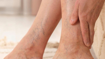 Γιατί πρέπει να χειρουργηθούν οι κιρσοί στα πόδια μου;