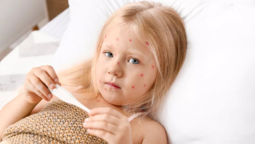 Ιλαρά και ερυθρά «επιστρέφουν» στην Ευρώπη – Η κατάσταση στην Ελλάδα
