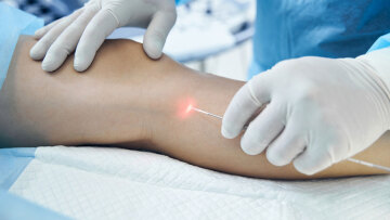 Το μέλλον στη θεραπεία κιρσών και φλεβικής ανεπάρκειας
