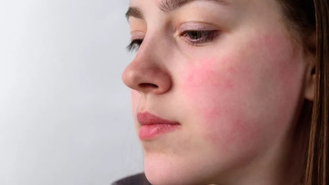 Δέρμα σε κατάσταση «συναγερμού» – Οι λύσεις που χαρίζουν ανακούφιση τον χειμώνα
