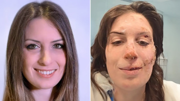 «Η ψυχή χρειάζεται περισσότερο χρόνο για να επουλωθεί»: Εξιτήριο για 29χρονη μετά τη φωτιά στο Κραν Μοντανά, ο μακρύς δρόμος της αποκατάστασης