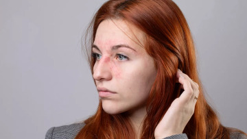 Σπάνιες παθήσεις δέρματος: Το παράδειγμα του Εθνικού Κέντρου Εμπειρογνωμοσύνης για δερματικά λεμφώματα στο ΑΤΤΙΚΟΝ