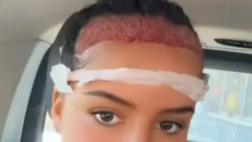 16χρονη ταξίδεψε στην Τουρκία για να βάλει μαλλιά: Το αποτέλεσμα μετά από έναν χρόνο έγινε viral