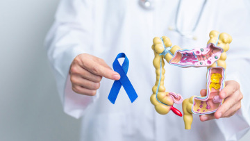 Καρκίνος παχέος εντέρου: Γιατί αυξάνεται στα άτομα κάτω των 50;