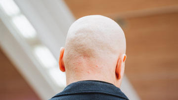 Τέλος η φαλάκρα; Το νέο προϊόν από την Κίνα που υπόσχεται επανεμφάνιση μαλλιών μέσα σε λίγες εβδομάδες
