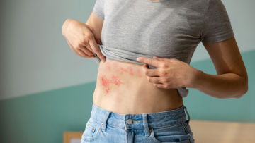 Έρπητας ζωστήρας: 8 στους 10 υποτιμούν τη βαρύτητα της νόσου - Ποιοι είναι πιο πιθανό να νοσήσουν