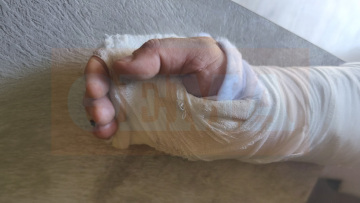 «Με χτυπούσαν στο κεφάλι 3 Πακιστανοί» λέει ο οδηγός του απορριμματοφόρου που ξυλοκοπήθηκε στη Νίκαια