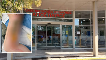 Εφιάλτης για 20χρονη στη Θεσσαλονίκη: Μπήκε στο νοσοκομείο για αφαίρεση κύστης κόκκυγα και κατέληξε με εγκαύματα τρίτου βαθμού