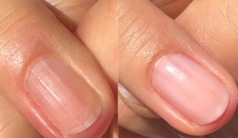 Τι σημαίνουν οι αυλακώσεις στα νύχια μας;