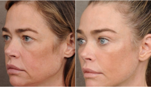 Ντενίζ Ρίτσαρντς: Φωτογραφίες με το πρόσωπό της πριν και μετά το λίφτινγκ