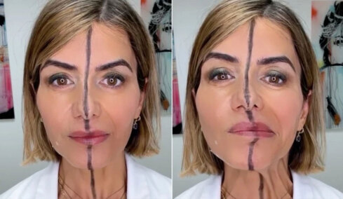 Γιατρός έκανε botox στη μισή πλευρά του προσώπου της: Τα αποτελέσματα ήταν σοκαριστικά (vid)