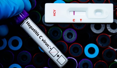 Ηπατίτιδα C: Καινοτόμο rapid τεστ ανιχνεύει τη λοίμωξη μέσα σε 15 λεπτά