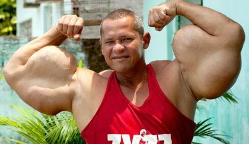 Βραζιλιάνος «Ποπάι» πέθανε στα 55 του, είχε γίνει διάσημος από τις ενέσεις με έλαια για να αποκτήσει μεγάλα μπράτσα