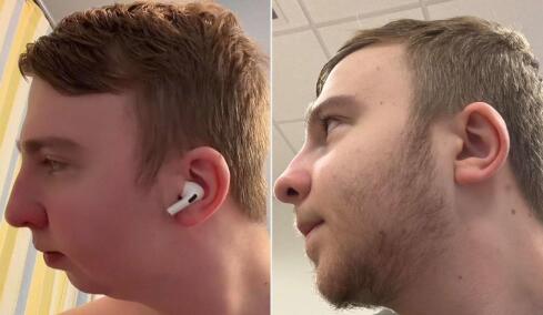 Ο άνθρωπος που υποβλήθηκε σε διπλή επέμβαση γνάθου: Η μεγάλη αλλαγή στην εμφάνισή του