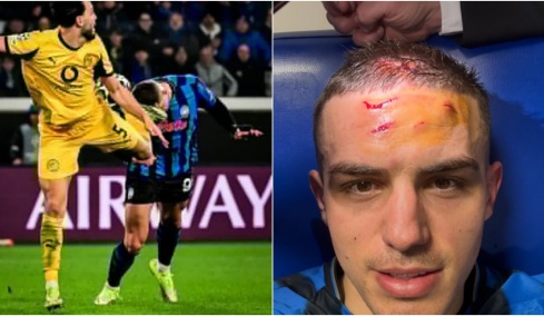 Αταλάντα: Η σοκαριστική φωτογραφία του Κρστόβιτς από την κλωτσιά του Μπενσεμπαϊνί
