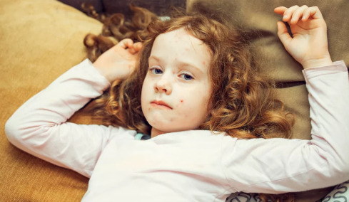 Ιλαρά: Οι ΗΠΑ ξεπέρασαν τα 1.100 κρούσματα μέσα σε 2 μήνες – Αναμένονται νέοι θάνατοι