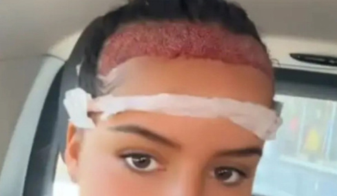 16χρονη ταξίδεψε στην Τουρκία για να βάλει μαλλιά: Το αποτέλεσμα μετά από έναν χρόνο έγινε viral