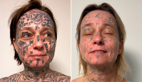 Απίστευτη κακοποίηση στην Ολλανδία: Έκανε τατουάζ 250 φορές το όνομά του στο κορμί της κοπέλας του!