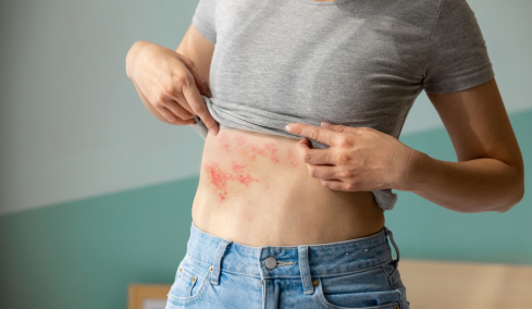 Έρπητας ζωστήρας: 8 στους 10 υποτιμούν τη βαρύτητα της νόσου - Ποιοι είναι πιο πιθανό να νοσήσουν