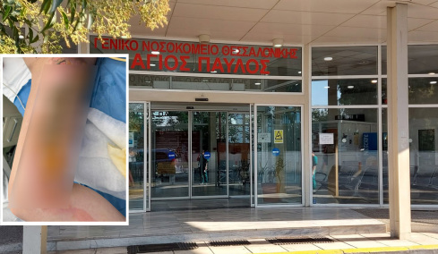 Εφιάλτης για 20χρονη στη Θεσσαλονίκη: Μπήκε στο νοσοκομείο για αφαίρεση κύστης κόκκυγα και κατέληξε με εγκαύματα τρίτου βαθμού