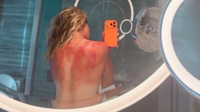 «Ο ήλιος της Αυστραλίας δεν αστειεύεται»: Το πάθημα της τενίστριας Ρενάτα Ζαραζούα πριν το Australian Open
