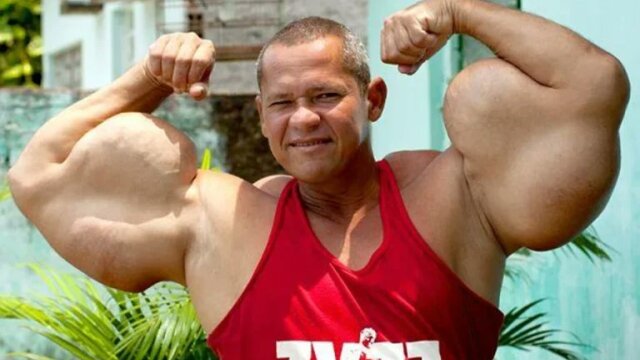 Βραζιλιάνος «Ποπάι» πέθανε στα 55 του, είχε γίνει διάσημος από τις ενέσεις με έλαια για να αποκτήσει μεγάλα μπράτσα
