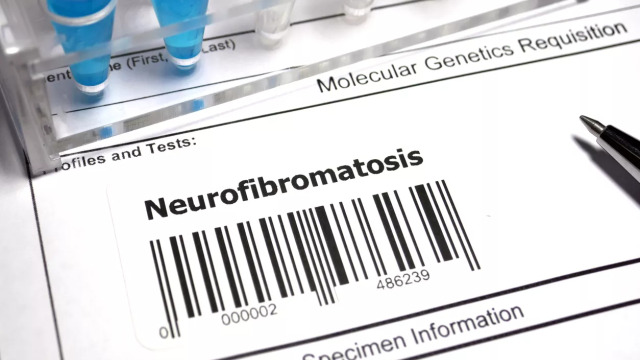 NF: Η σπάνια γενετική πάθηση που περιορίζει την αυτονομία – Καθυστερημένη διάγνωση για 1 στους 3 ενήλικες