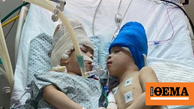 Conjoined Twins With Fused Brains Successfully Separated Thanks To Uk Surgeon