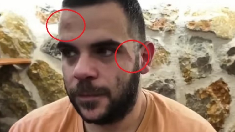 Ο Youtuber Teosty για τον ξυλοδαρμό του στα Γιάννενα: Δεν φοβήθηκα, δείχνω τα σημάδια για να καταλάβουμε ότι η βία είναι πραγματική